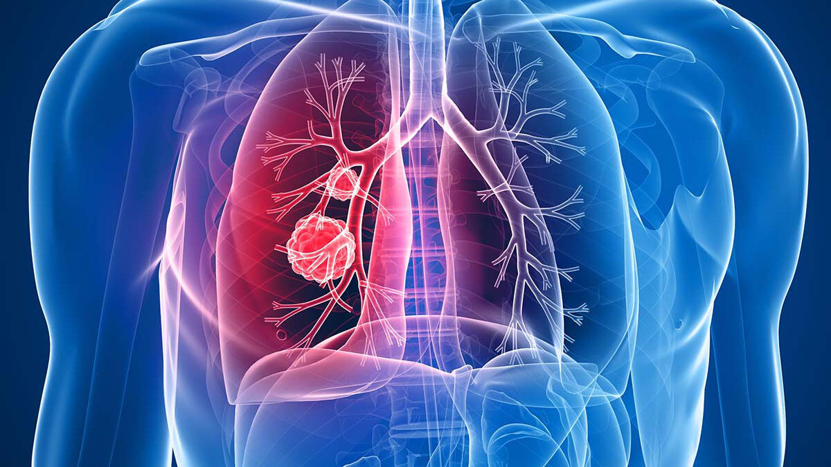 https://cos.sonicmobi.com/uploads/Lung-cancer-1200x675-1792661286261i9r7531reck.jpg