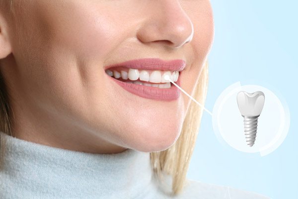 The Future of Dental Health: Screwless Dental Implants