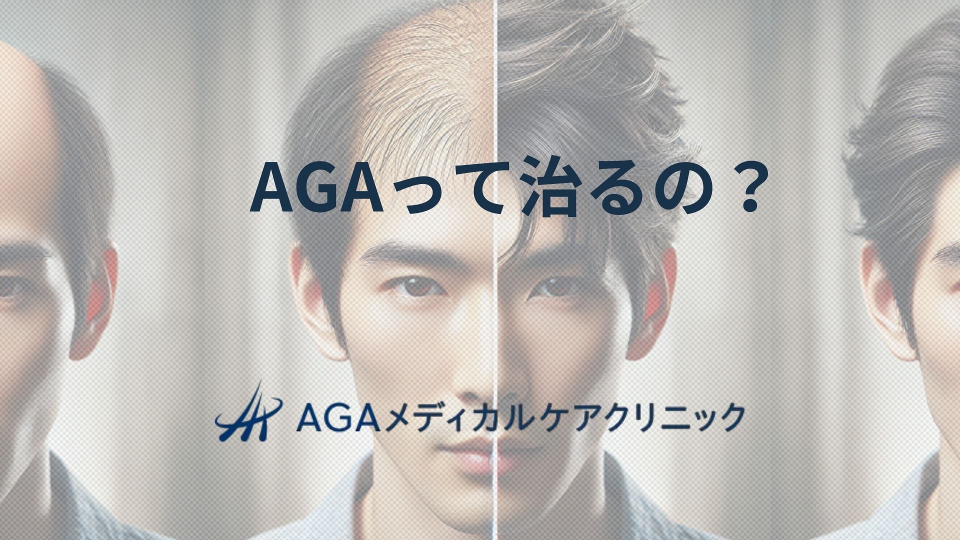 AGA治療を考える前に|薄毛・抜け毛の相談先と費用の見方